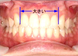 乳歯と永久歯の大きさ